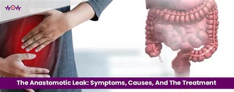 anatasialysa leak|Anastomotic Leak: Symptoms, Treatment & What It Is.